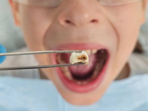 Best Knocked-Out Tooth Emergency  in Otsego, MN